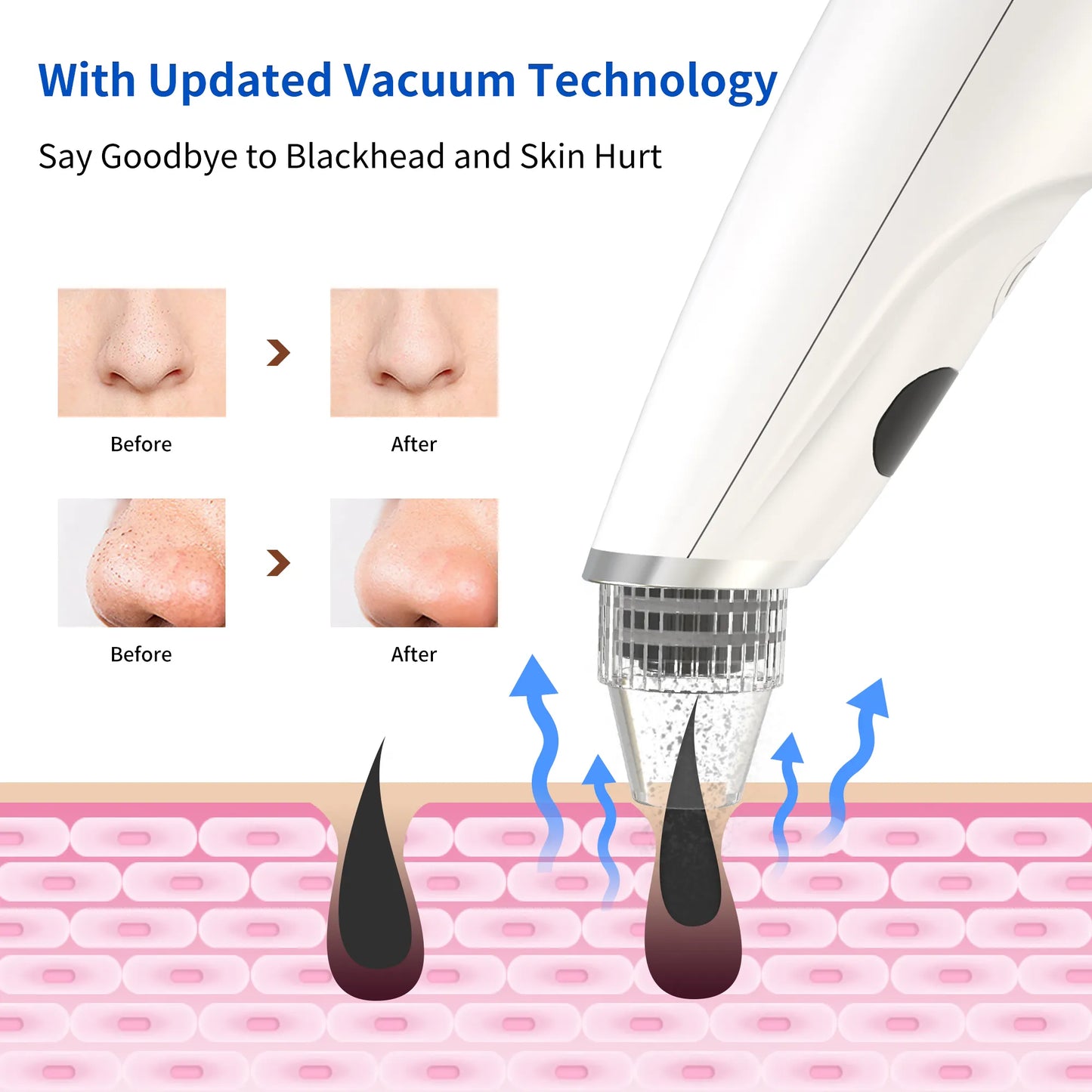 Pore Cleaner Black Head Acne Treatment Suction Extractor Facial and Whitehead Head Electronic Blackhead Remover Vacuum