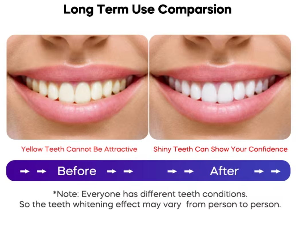 GLORY SMILE 16 Minutes Violet 405NM Light Teeth Whitening Led Kit With 6 PAP Gel Tube