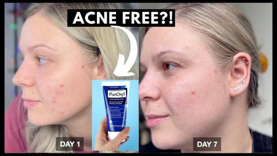 PanOxyl Acne Foaming Wash Benzoyl Peroxide 10% Maximum Strength-Health & Beauty-Eclatbody-panoxyl-