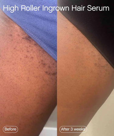 High Roller Ingrown Tonic With AHAs + BHAs